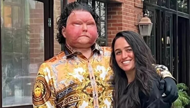 Dünya’da birinci defa birebir bireyden hem yüz hem de çift el nakli yapılan adam nişanlandı